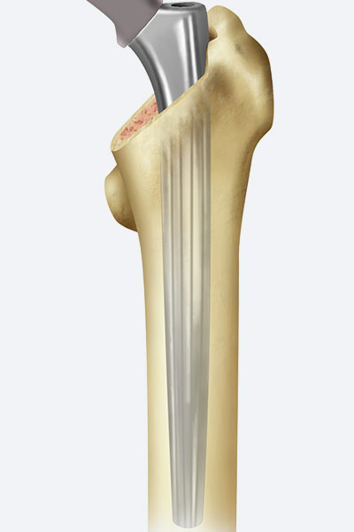 Advita Hip Revision Femoral Alteon Monobloc Trial Placement