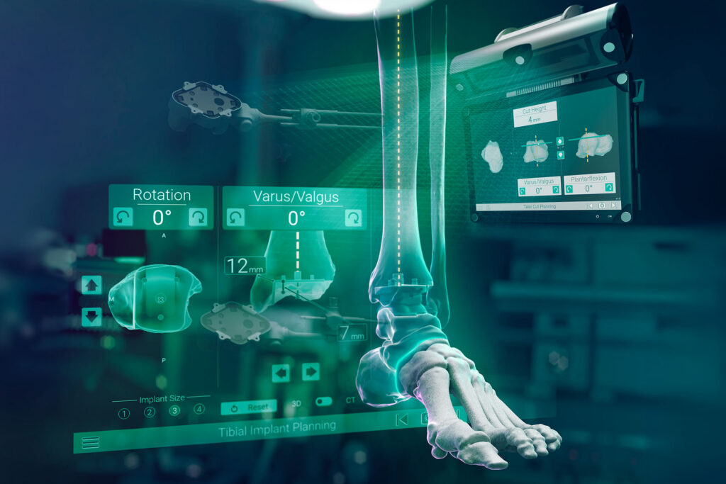 GPS Ankle Navigation for Total Ankle replacement surgery