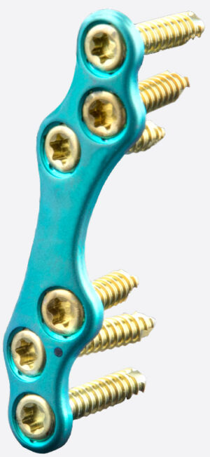 EPIC Extremity Foot and Ankle Reconstruction System Great Toe Arthritis Construct