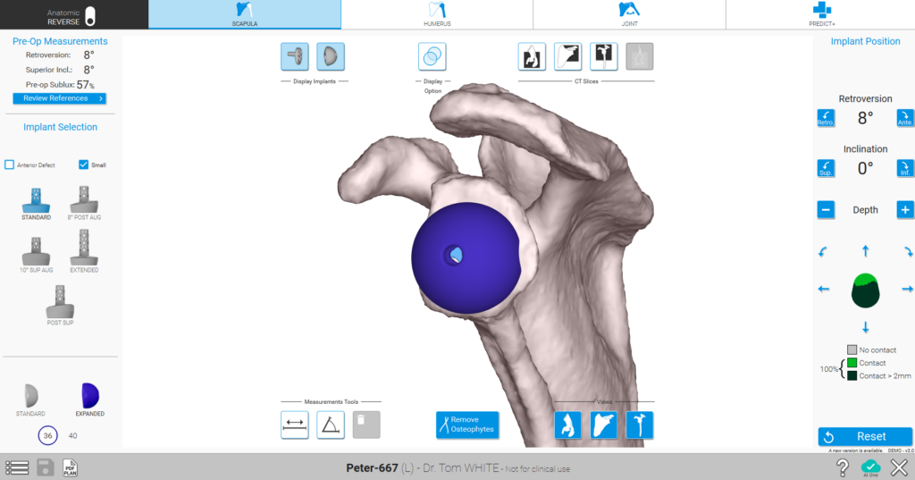 Shoulder Planning App Scapula Screen