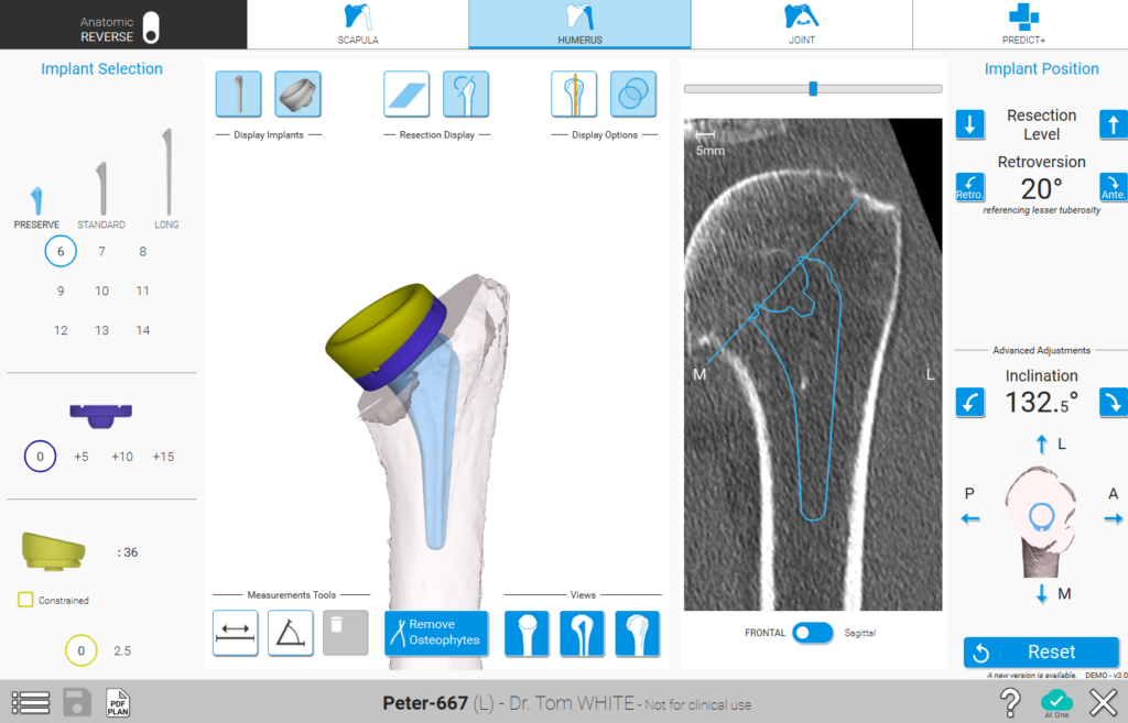Shoulder Planning App Humerus Planning Screen