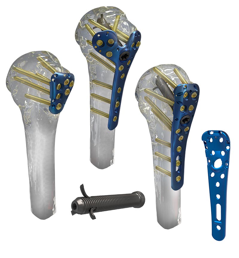 Equinoxe® PHx Proximal Humeral Fracture System