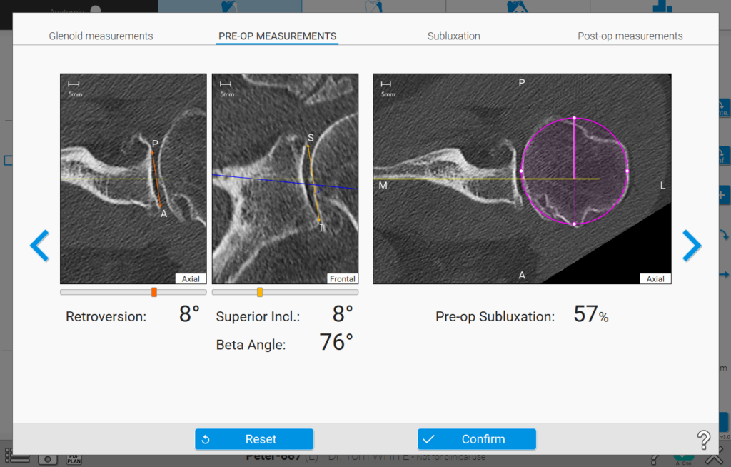 Shoulder Plannig App Automated Advanced Measurements Tool