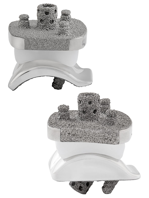 Vantage Total Ankle Replacement System