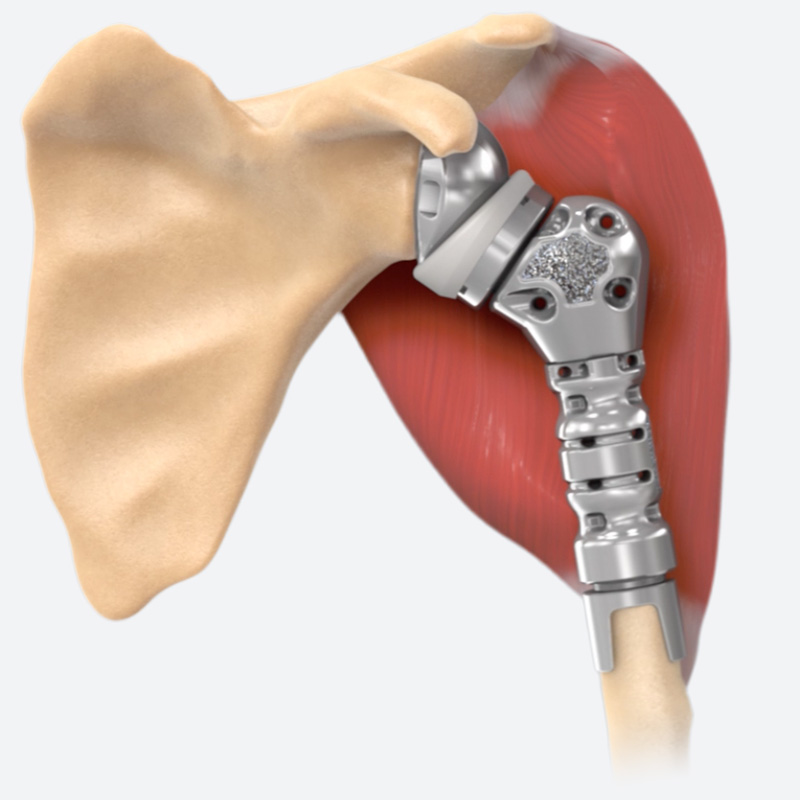 Equinoxe Complex Humeral Shoulder Solutions Humeral Reconstruction Prosthesis Biomechanics Illustration