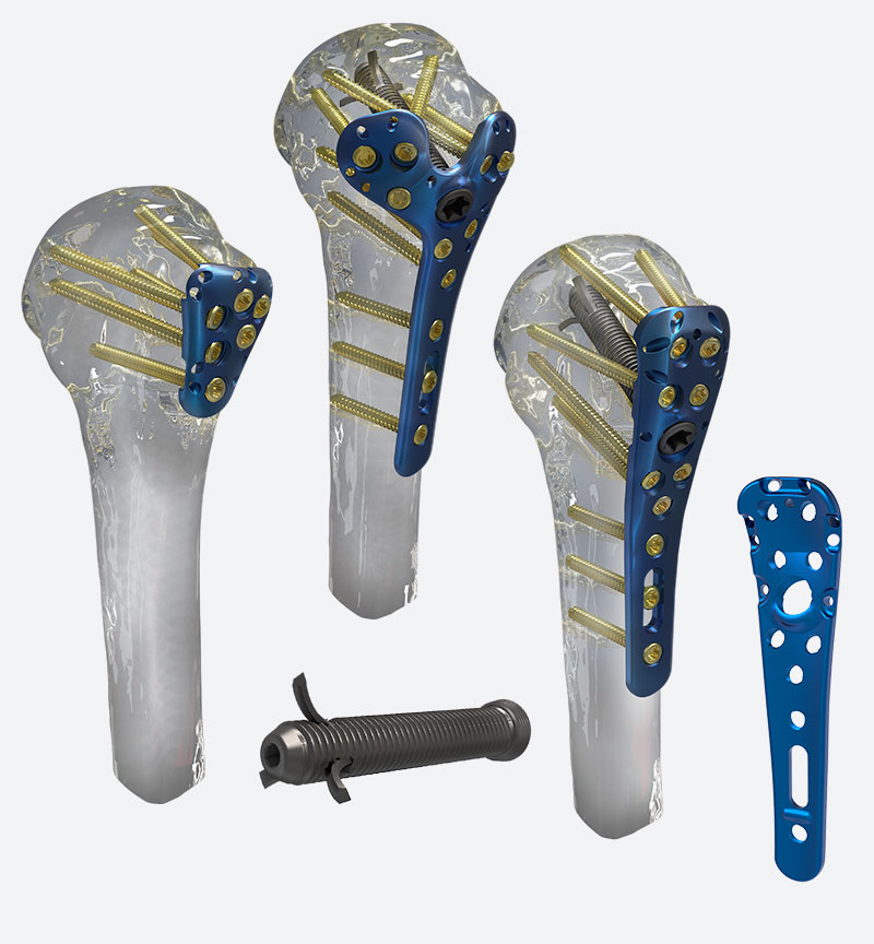 Equinoxe PHx Proximal Humeral Fracture System