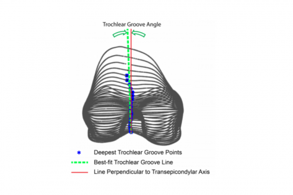 Drawing of Fit of Modern Femoral Knee Implant Design