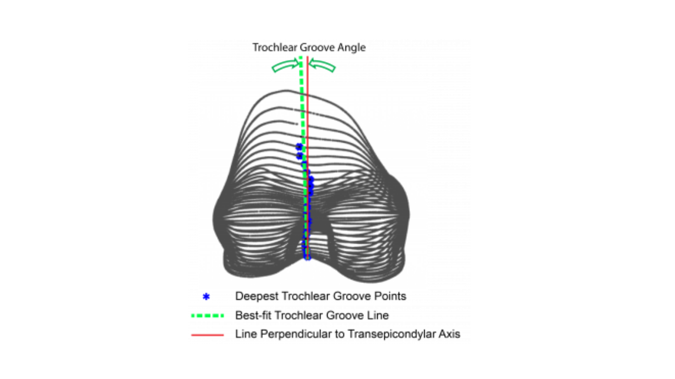 Drawing of Fit of Modern Femoral Knee Implant Design