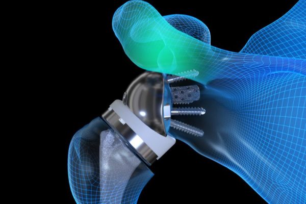 Equinoxe Reverse Shoulder Implant Illustration