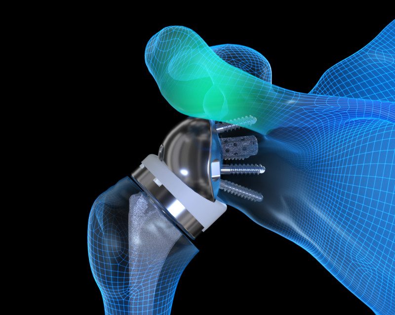 Equinoxe Reverse Shoulder Implant Illustration