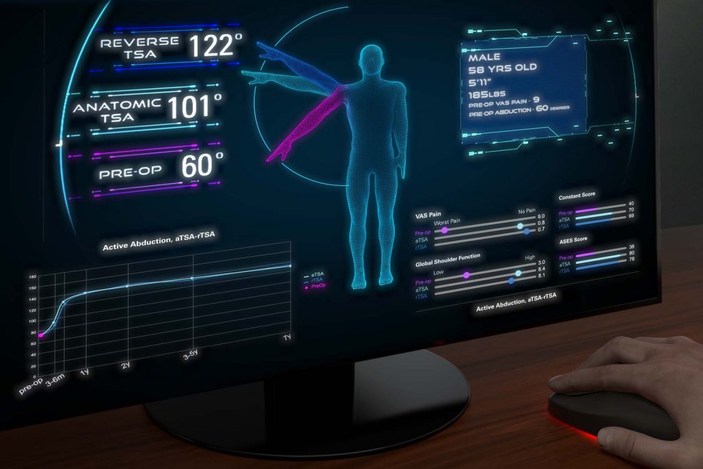 Decision Making in Shoulder Arthroplasty using Active Intelligence AI Technology Predict+