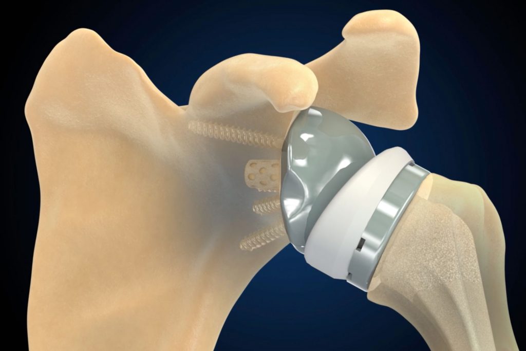 Advita Ortho Shoulder Reverse Illustration