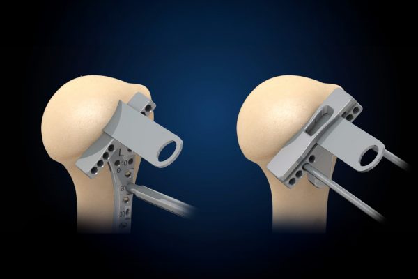 Advita Equinoxe Ergo Instruments on Reverse Shoulder Humeral Head Resection