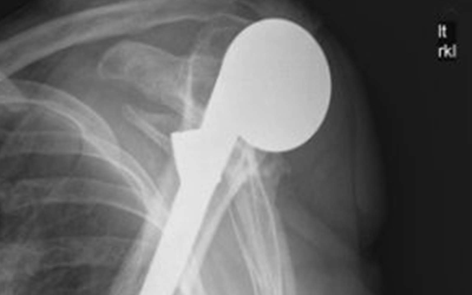 Failure of Trabecular Metal-Backed Glenoids