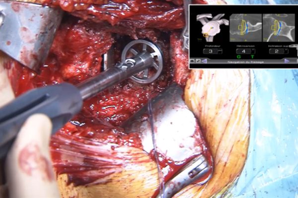 AdvitaGPS and Equinoxe Shoulder Navigation Surgery