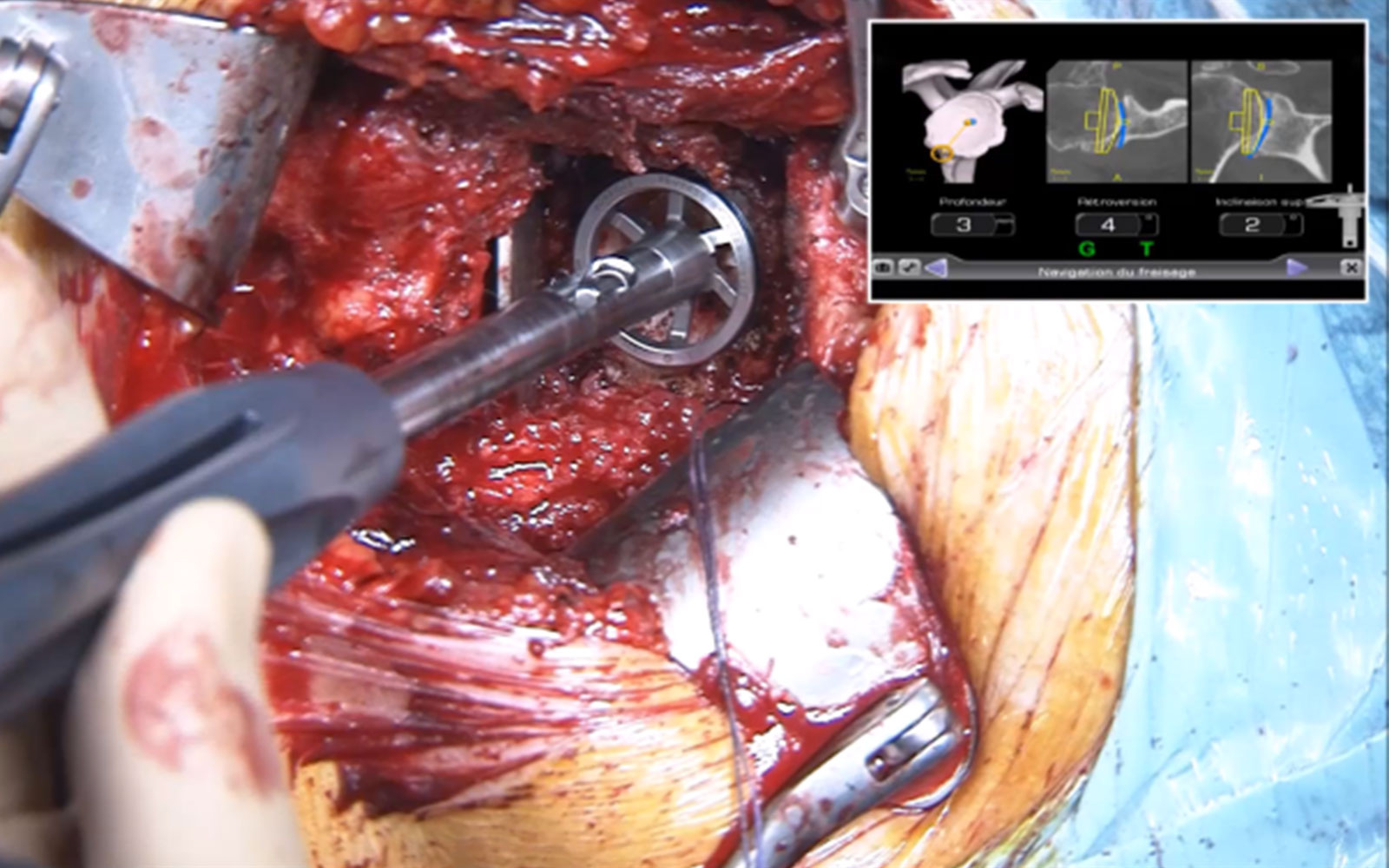 AdvitaGPS and Equinoxe Shoulder Navigation Surgery