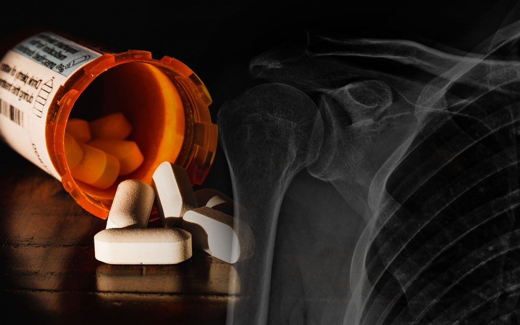 Opiod free shoulder arthroplasty