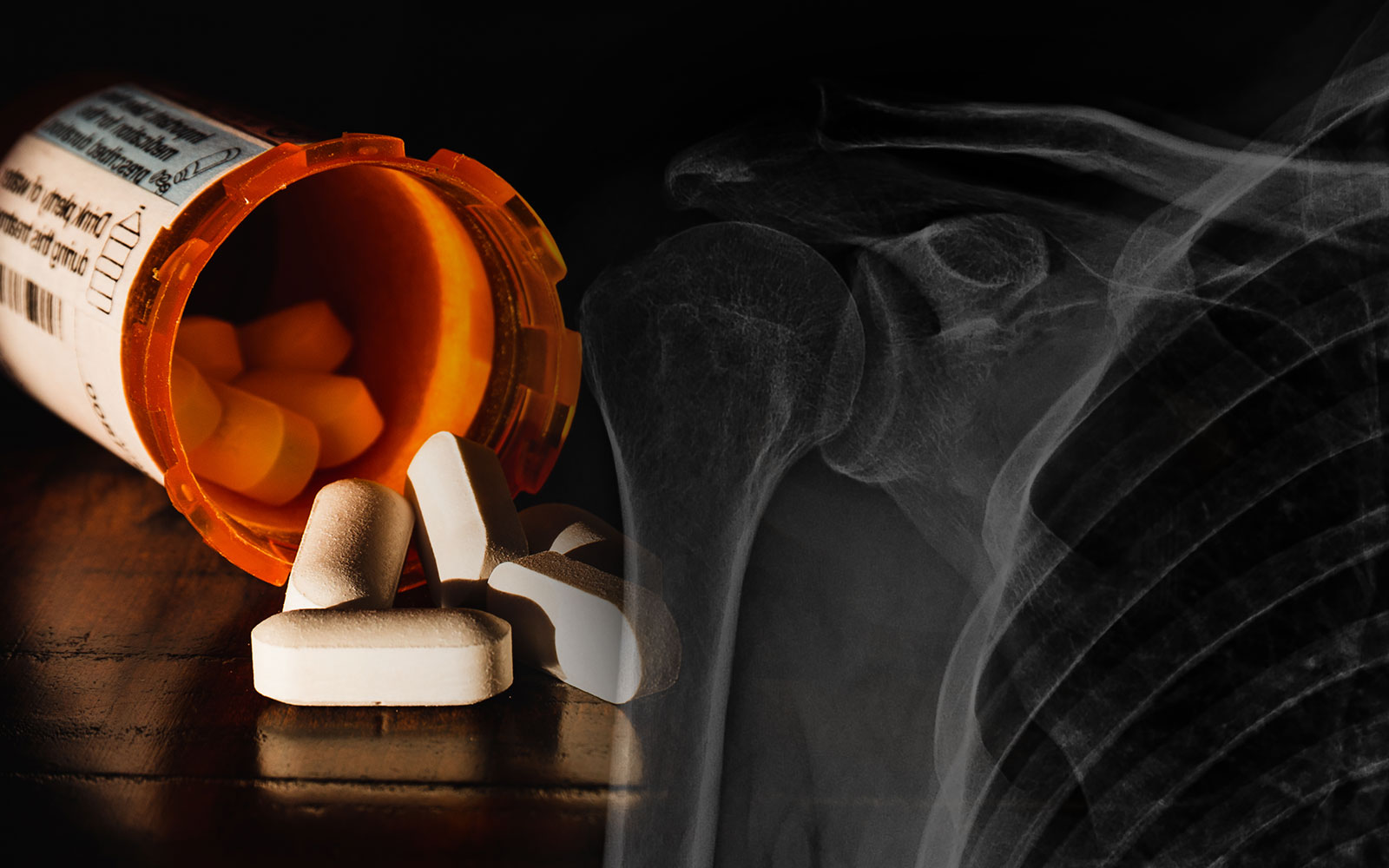 Opiod free shoulder arthroplasty