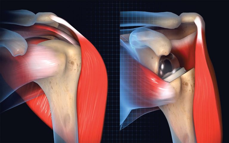 Shoudler Bio Rsa Innovations | Scapular Fractures After RSA – The Bane of Our Existence