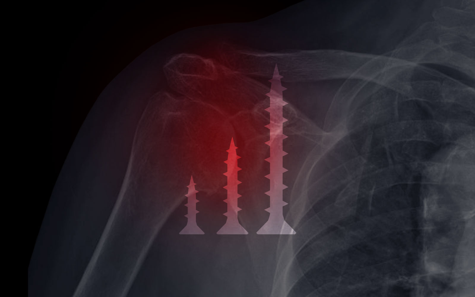 Screw Length vs Quantity in rTSA