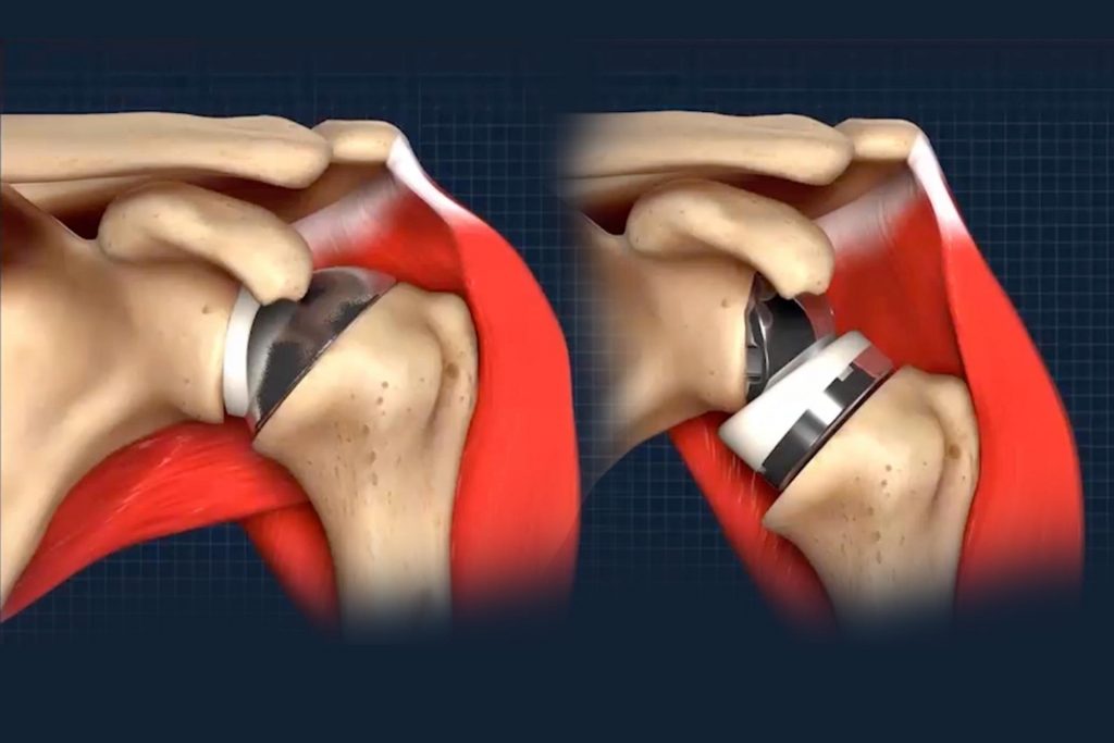 A Review of Convertible-Platform Shoulder Arthroplasty Shoulder Illustrations