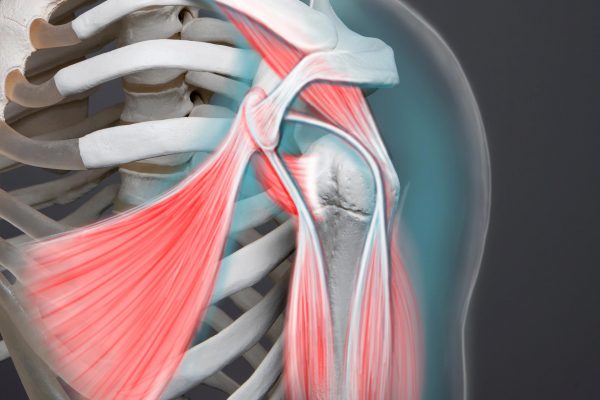 Pectoralis Minor Tenotomy in Shoulder Arthroplasty A Novel Therapeutic Approach