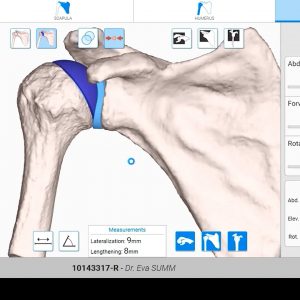 Navigating aTSA: Surgical Video with New Planning App, GPS Shoulder and Equinoxe Ergo Instruments – Featuring Howard Routman, DO