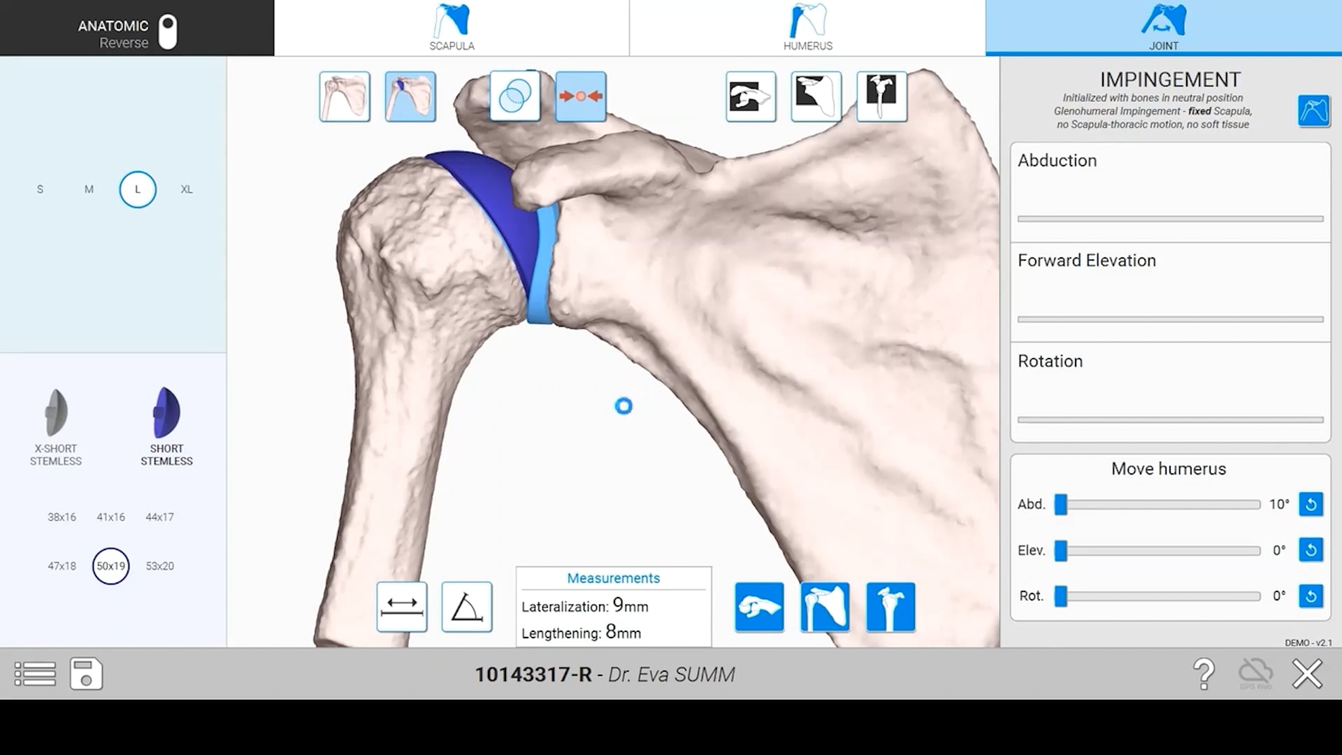 Navigating aTSA: Surgical Video with New Planning App, GPS Shoulder and Equinoxe Ergo Instruments – Featuring Howard Routman, DO