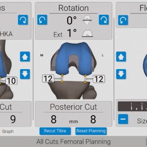 GPS Knee Newton Balancing Surgery: Tibia-First Workflow – Featuring Paul Freudigman, MD