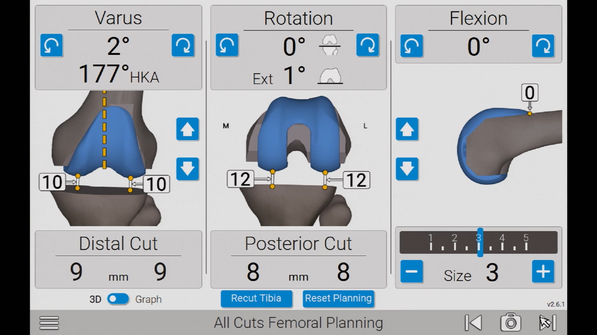 GPS Knee Newton Balancing Surgery: Tibia-First Workflow – Featuring Paul Freudigman, MD