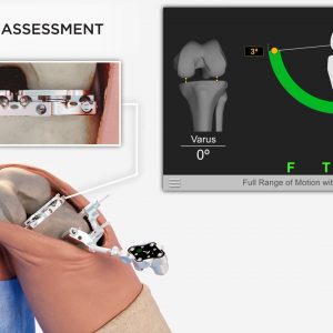 Newton Balanced Knee Replacement Surgery Patient Animation by Advita