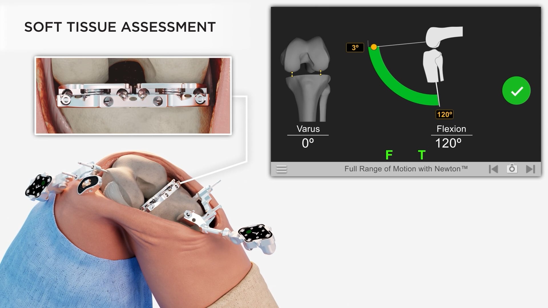 Newton Balanced Knee Replacement Surgery Patient Animation by Advita