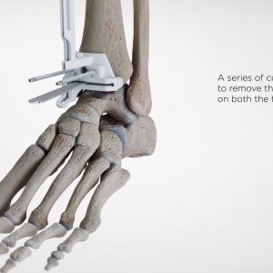 Advita Ortho Vantage Ankle PSI Patient Animation