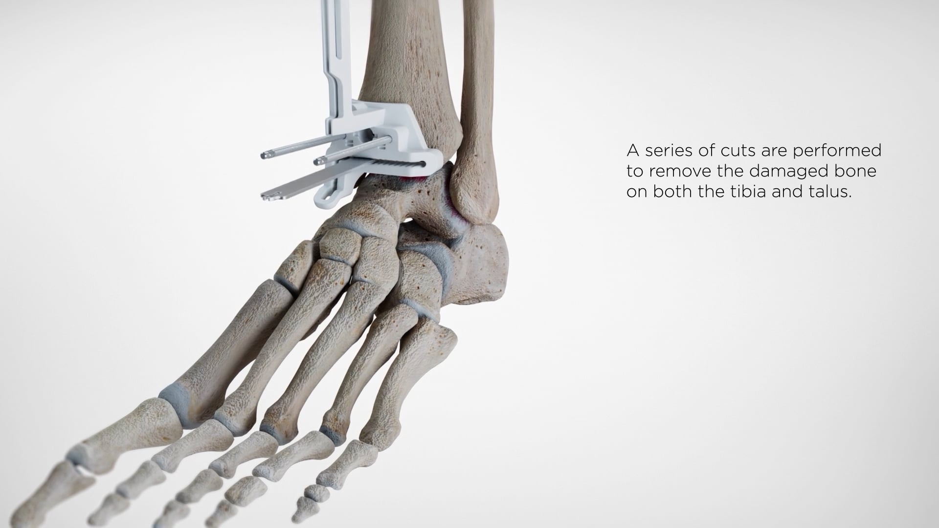 Advita Ortho Vantage Ankle PSI Patient Animation