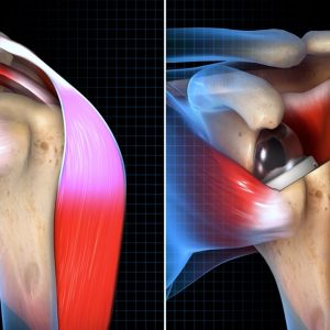 Biomechanical Summary of Equinoxe Reverse Shoulder Arthroplasty