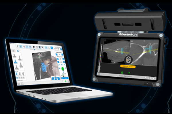 Advita GPS navigation for shoulder arthroplasty is shown on computer for preop planning and on screen for intraoperative application