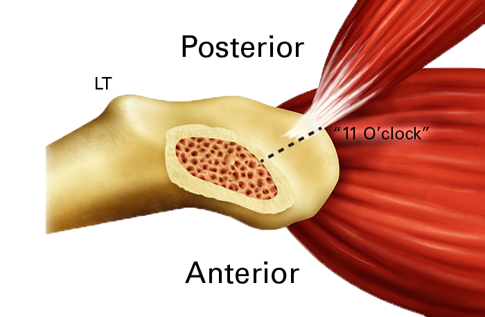 direct anterior approach for total hip arthroplasty hip illustration