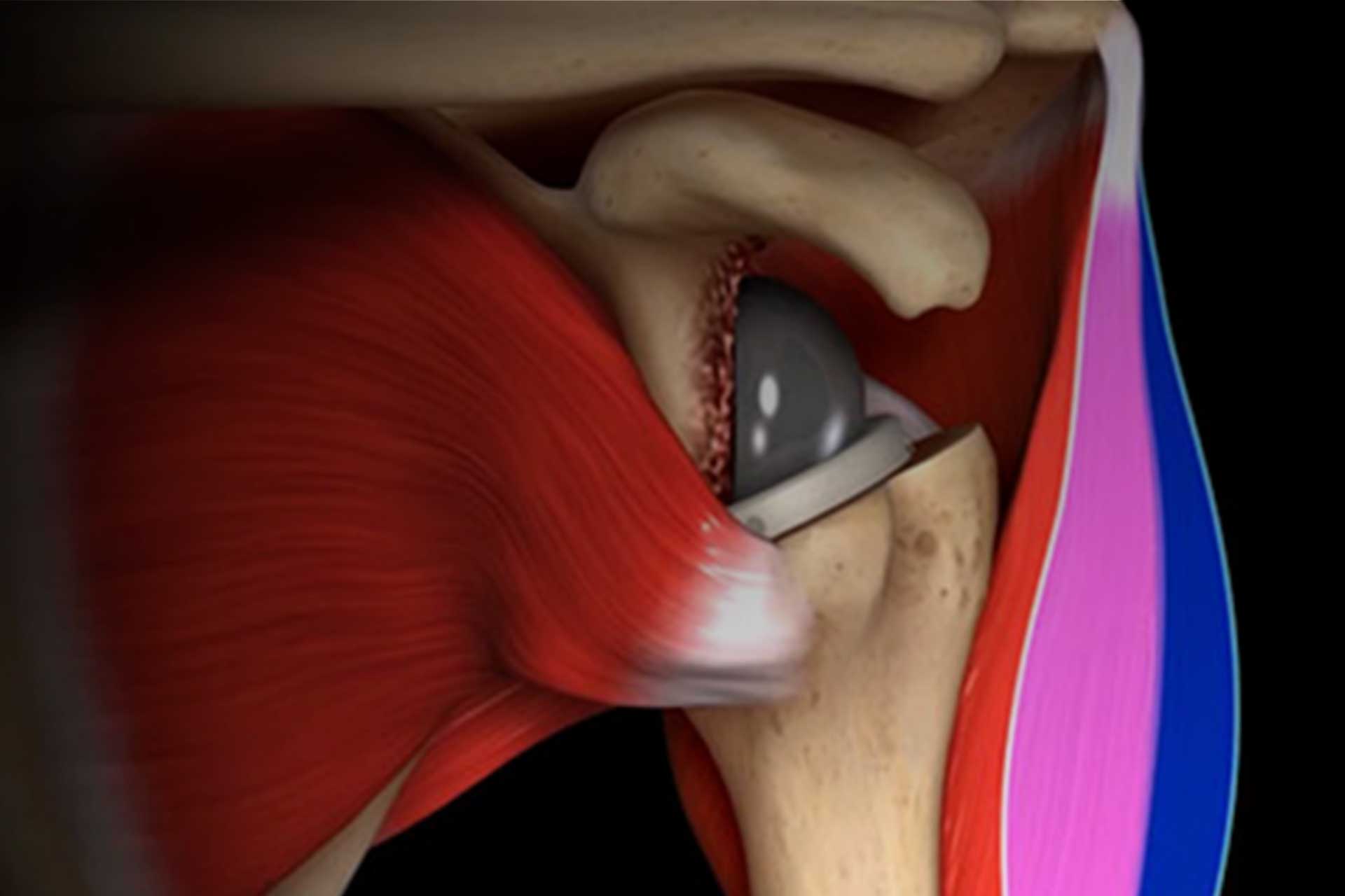Reverse Shoulder Biomechanics and Scapular Notching Shoulder Illustration