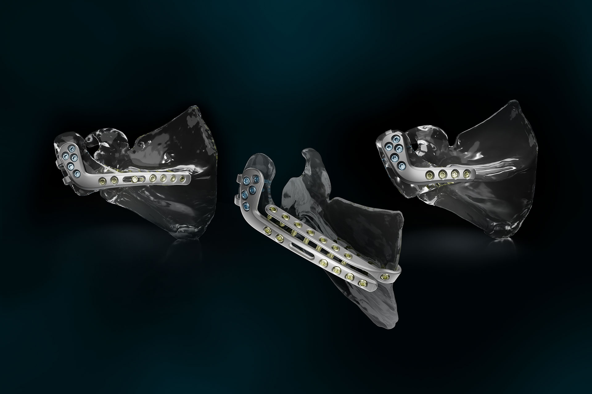 Equinoxe Scapula Reconstruction System for Acromion Fractures