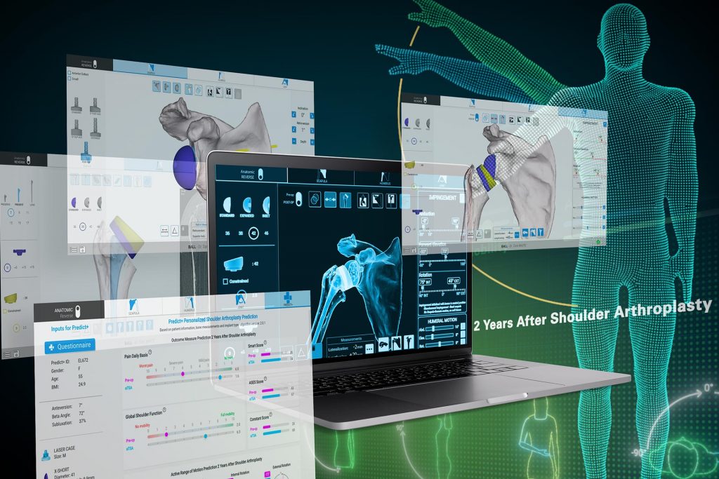 Comparing 3D Computer-assisted Planning With and Without Patient-specific Instrumentation Shoulder Planning App Illustration