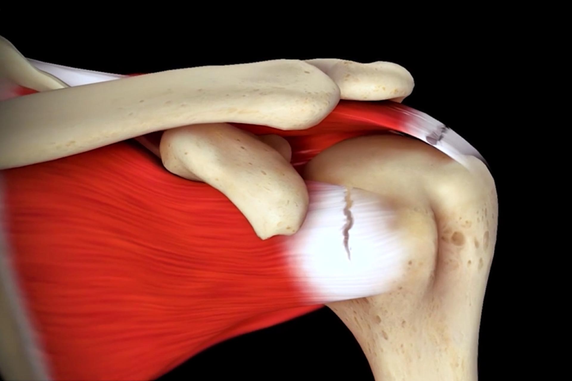 Optimizing distalization and lateralization in reverse arthroplasty for cuff arthropathy, shoulder tear illustration