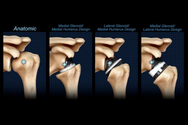 The effect of reverse shoulder arthroplasty design and surgical indications on deltoid and rotator cuff muscle length Illustration of Shoulders and implant tpes