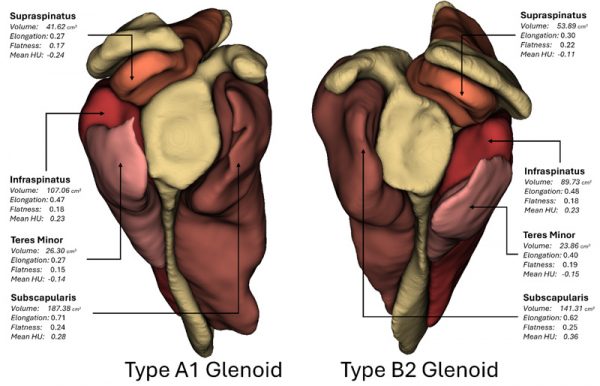 Representative Depiction of Scapular Bone and Rotator Cuff Muscle 3D CT Reconstructions of a Patient with a Walch A1 Glenoid (left) and a Walch B2 Glenoid (right); Associated Radiomic Measurements are Shown.
