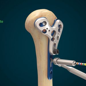 Equinoxe PHx Proximal Humeral Fracture System Surgical Animation