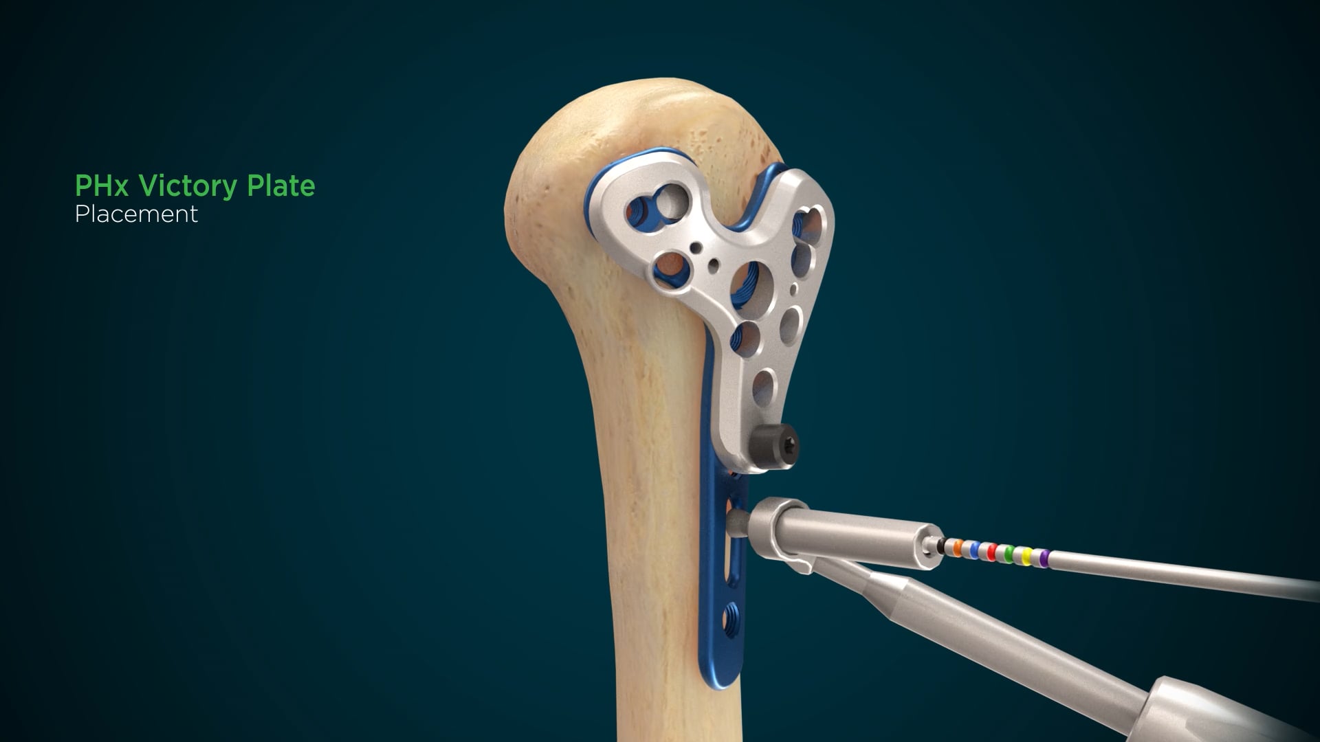 Equinoxe PHx Proximal Humeral Fracture System Surgical Animation