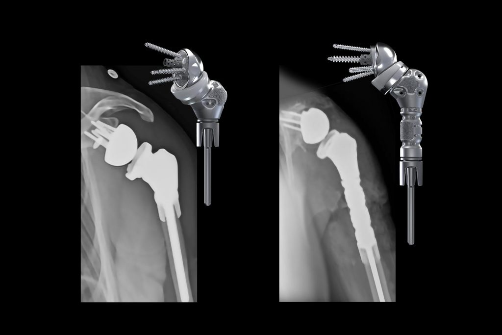 Reimagining Shoulder Reconstruction Reverse Humeral Reconstruction 