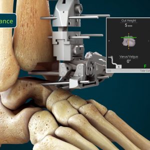 Advita Ortho's GPS Ankle TAA Surgical Animation