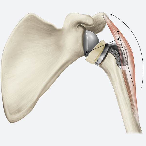 Advita Ortho Equinoxe Humeral Augmented Tray (HAT) with Activit-E vitamin-E polyethylene