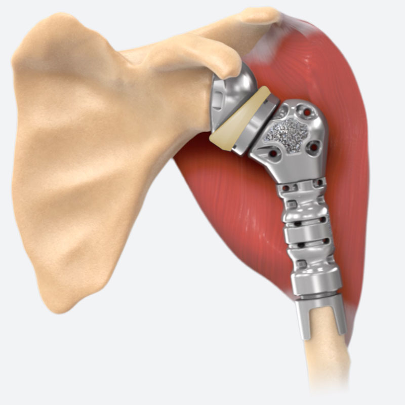 Advita Ortho Equinoxe Humeral Augmented Tray (HAT) with Activit-E vitamin-E polyethylene illustration of Biomechanics