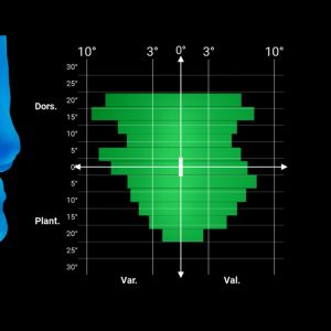 Advita GPS Ankle: Navigation for Vantage Total Ankle Replacement